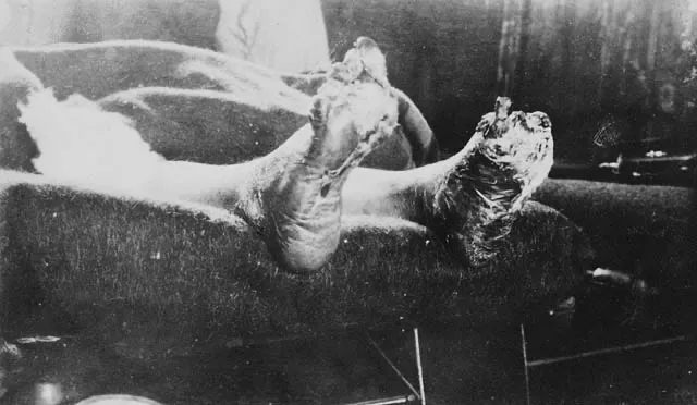 " Title / Titre : Case of trench feet suffered by unidentified soldier / Cas de pieds des tranchées (soldat non identifié) Creator(s) / Créa